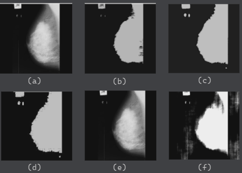Medical mammogram images demonstrating steganographic protection techniques: (a) Original Mammogram; (b) Segmented Mammogram; (c) Dilated Mammogram; (d) Block Separation; (e) stego-Mammogram; (f) Masked Mammogram